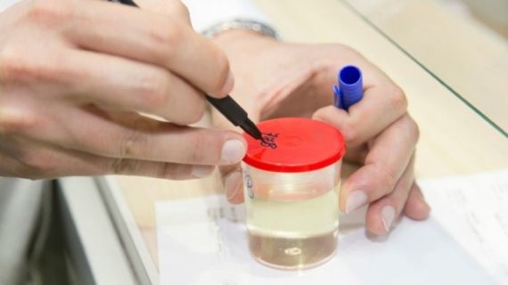 Cervical cancer: Researchers develop urine test for early, easy detection