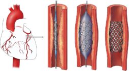 First made in India dissolvable stents approved by government