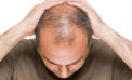 Scientists come close to finding a cure for baldness