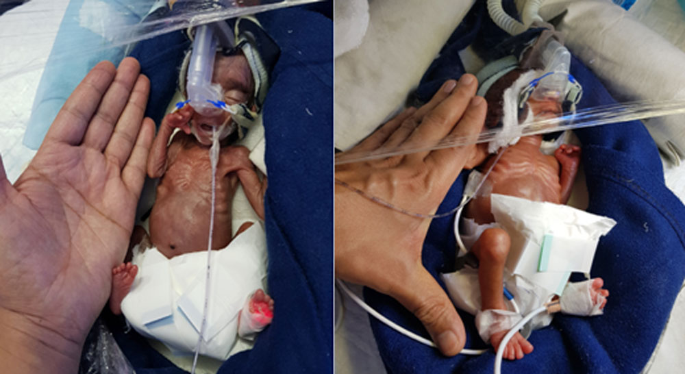 Miraculous-Survival-of-Tiny-Twin-Babies-eng